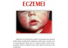 Cum sa faci fata eczemei - Jill Eckersley